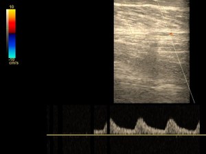 Miażdżycowe zwężenia tętnic.
