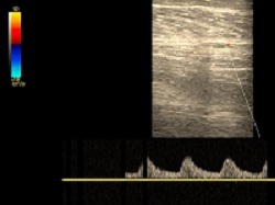 Miażdżycowe zwężenia tętnic