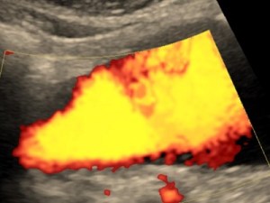 Tętniak aorty brzusznej w badaniu usg doprowskim.