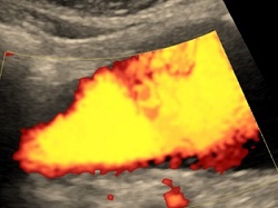 Tętniak Aorty brzusznej