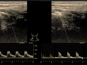 Doppler tętnic szyjnych.