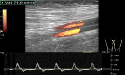 Zwężenie tętnicy biodrowej
