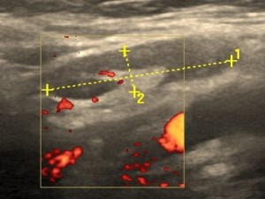 Węzeł chłonny w USG