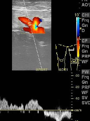 doppler żylaków - spektrum przepływu - refluks patologiczny