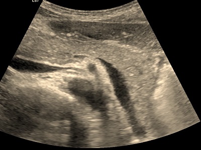 usg trzustki - dobrze widoczna echostruktura i fragment wątroby